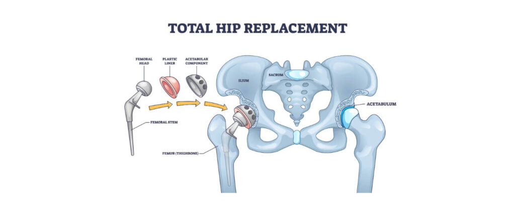 Hip Replacement Rehab: Tips for a Successful and Speedy Recovery