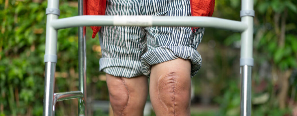 Post Operative Exercises for knee in Taxes